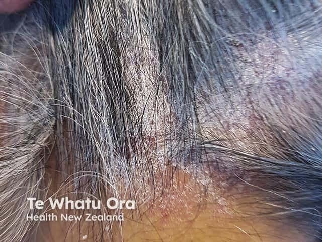 Clinical photography of the scalp depicting classic psoriasis plaque with silvery, adherent scale and erythematous background. Modality: External examination photography (dermatologic/clinical image) performed with standard bedside lighting, no dermoscopy or biopsy required for this description. Anatomical site: scalp skin, including crown and temporal regions, representing a hair-bearing area with regional alopecia potential from plaque coverage. Visual features: well-demarcated erythematous plaques, multilayered, lamellar silver scales, follicular plugging variations, mild edema at lesion margins, and diffuse desquamation. The plaques may extend to adjacent occipital scalp; involvement may be limited to seborrheic-like areas or generalized scalp involvement. The lesion morphology is plaque-type (psoriatic) with erythema, scaling, and mild but non-purulent irritation. Pathologic correlate (not shown) would be psoriatic epidermal hyperplasia with parakeratosis and neutrophilic microabscesses (Munro) on histology; clinically, this appearance correlates with psoriasis vulgaris, plaque type. Diagnostic significance: characteristic scalp psoriasis demonstrates a chronic relapsing course, responds to topical corticosteroids, vitamin D analogs, or combination therapies; helps differentiate from seborrheic dermatitis and tinea capitis. Clinical use: educational reference for dermatology trainees, triage for systemic evaluation, and documentation of typical scalp disease for monitoring treatment response and disease extent. The image serves as a representative example for scalp involvement in psoriasis and related inflammatory dermatoses.