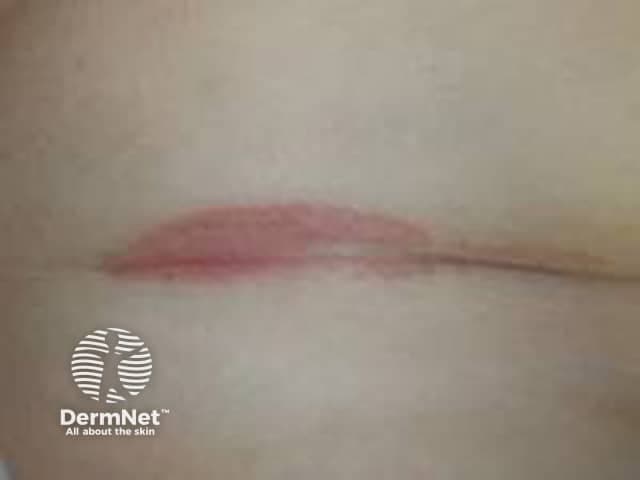 Clinical photography of the antecubital fossa region shows a single erythematous plaque within a flexural skin fold. The lesion is well-demarcated, with a smooth pink-to-erythematous surface and minimal scales evident, reflecting inverse/ flexural psoriasis features in moist environments where scaling is less conspicuous. The plaque lies centrally within the fold, with intact surrounding skin and no obvious crusting or excoriation. Lighting emphasizes a uniform coloration without effusion or ulceration. The regional skin may appear slightly edematous or glistening from moisture, a common appearance in intertriginous psoriasis. In clinical practice, such lesions are often symmetric or multipart and may co-occur with plaques on extensor surfaces; history of chronic plaque psoriasis or family history supports the diagnosis. Differential considerations include irritant dermatitis, candidal intertrigo, or seborrheic dermatitis; biopsy would reveal epidermal hyperplasia with parakeratosis and neutrophilic microabscesses typical of plaque psoriasis, though histology is not demonstrated here. The image is intended for dermatology education, aiding recognition of flexural psoriasis, differentiation from dermatitis, and guiding topical therapy, including high-potency corticosteroids or vitamin D analogs with occlusion, while avoiding excessive moisture. This photo supports image-based teaching, clinical pattern recognition, and correlation with patient history in practice and research.