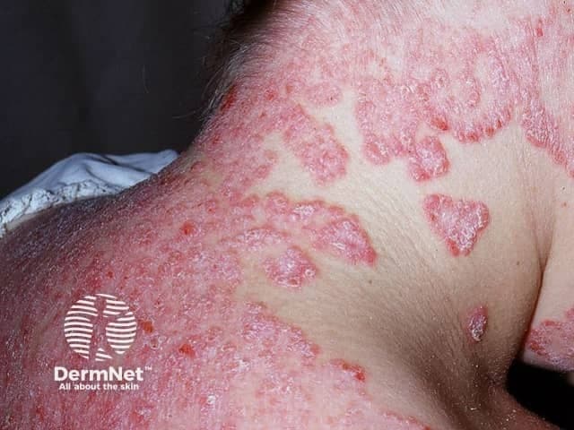 Clinical photography of facial skin demonstrates classic psoriatic plaques involving the malar region and surrounding cheeks. The lesions are erythematous to violaceous, well-demarcated, and markedly scaly with silvery-white scale, consistent with plaque-type psoriasis (psoriasis vulgaris). Involved areas show surface coarseness, thickening (acanthosis) and mild induration, while adjacent skin remains relatively spared. Perilesional inflammation creates a ring of erythema, and some plaques exhibit superficial fissuring. The distribution is facial rather than scalp, trunk, or limbs, suggesting involvement limited to the head-and-face region in this image. No vesiculation or purulence is evident. The appearance may mimic seborrheic dermatitis, eczema, or contact dermatitis; however, the well-circumscribed plaques with thick scale and the typical red-silver presentation strongly favor psoriasis. Skin photo shows high-contrast textural differences between lesional and non-lesional skin. Clinically, facial psoriasis can be challenging due to cosmetic and functional concerns, including itching and social impact. This image supports differential diagnosis discussions in dermatology education and serves as a reference for recognizing facial plaque psoriasis, assessing severity, and guiding treatment planning (topical steroids, vitamin D analogs, or phototherapy). It is useful for teaching photodocumentation, lesion morphology, and pattern recognition in psoriasis spectrum. This image thus enhances reasoning for diagnosis, prognosis, and management planning.