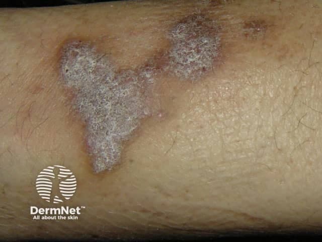 Clinical photography of in vivo forearm skin demonstrating classic plaque psoriasis morphology. The lesion cluster comprises erythematous to violaceous plaques with an overlying adherent silvery scale, coalescing along the extensor surface of the forearm. Adjacent skin appears mildly xerotic with visible hair and normal surrounding texture; margins are slightly raised, with hyperkeratotic borders. The pattern is characteristic of plaque-type psoriasis, though mosaic distribution may mimic eczematous dermatitis or fungal infection in some individuals. The imaging captures a single contiguous plaque complex and several smaller lesions in proximity, suitable for educational comparison with other dermatoses. If biopsy is performed, histopathology would likely reveal epidermal acanthosis, parakeratosis with neutrophilic Munro microabscesses, and irregular dermal capillary dilation; dermal inflammatory infiltrates would accompany. Clinically, this appearance implies a chronic relapsing condition requiring psoriasis-specific management, including topical corticosteroids, vitamin D analogs, calcineurin inhibitors in sensitive areas, or phototherapy and systemic agents for extensive disease. Differential diagnoses include nummular eczema, tinea corporis, seborrheic dermatitis, and pityriasis rosea variants. Diagnostic significance lies in guiding therapy, prognostication, and monitoring response to treatment. This image is relevant for dermatology education, teledermatology triage, and comparative studies of plaque psoriasis presentations. Accurate description enables coding, research indexing, and student assessment.