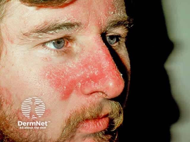 High-resolution color clinical photograph of an adult male’s central face focusing on the left cheek and nasal bridge. Modality: clinical photography; technique: close-up, color-accurate digital image captured under diffuse frontal lighting. The facial skin shows marked erythema centered on the malar region with diffuse redness extending toward the nasal ala and bridge. Subtle desquamation and fine scale may be present at the margins. The appearance is characteristic of seborrheic dermatitis, a common inflammatory dermatosis affecting sebaceous-rich areas of the face. The epidermis shows superficial inflammation without ulceration or vesiculation. The lesion margins are ill-defined and confluent, with variable textures from smooth erythema to flaky scales. There is no obvious crusting or infection. The surrounding skin appears unremarkable aside from mild erythema and oiliness. Clinically this image is valuable for dermatology education, differential diagnosis exercises (rosacea, contact dermatitis, atopic dermatitis), and monitoring therapeutic response to topical antifungal agents (ketoconazole) or anti-inflammatory regimens (selenium sulfide shampoo, zinc pyrithione, corticosteroids). In research, it supports studies of seborrheic dermatitis prevalence, severity grading, and cosmetic impact on quality of life. The image emphasizes visual cues used in bedside assessment, documentation, and tele-dermatology triage. Accurate annotation enhances searchability for educational archives and clinical databases for research.