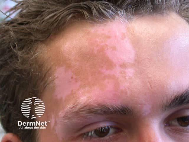 Clinical photography of a living patient displaying segmental vitiligo on the face. Frontal close-up of the forehead and periorbital/temporal region shows patches of depigmentation with sharply defined borders, ranging from pearl to porcelain white, and limited to a unilateral facial dermatomal distribution. Affected areas are hypopigmented to depigmented with uniform color loss and no visible scale or erythema. The surrounding skin shows mild hyperpigmentation at the lesion margins and subtle perifollicular pigment. The imaging modality is standard white-light dermatologic photography; no dermoscopic magnification or fluorescent staining is used. This presentation is typical for segmental vitiligo, an autoimmune melanocyte destruction pattern that often follows a dermatomal distribution and tends to progress rapidly before stabilization. The image demonstrates key diagnostic features including crisp lesion borders and absence of pigment in the epidermis on histology would be expected, but is not visible here. Clinically, vitiligo patches are often more conspicuous in darker skin types and are prone to Koebner phenomenon with friction or trauma. Relevance includes differential diagnosis against post-inflammatory hypopigmentation, pityriasis alba, and fungal hypopigmentation, and relevance for therapeutic planning such as topical corticosteroids, calcineurin inhibitors, photoprotection, and consideration of light therapy. Documented patch stability and follow-up imaging inform treatment decisions effectively.