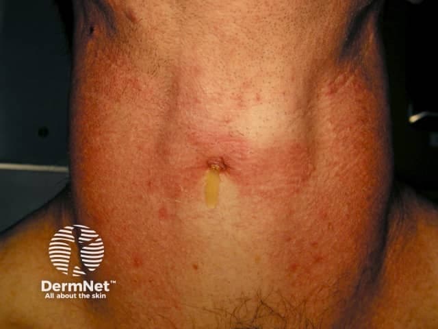 Clinical photograph of the anterior neck illustrating diffuse enlargement of the thyroid region consistent with a goiter. The image is a frontal view capturing the patient from the chin to the upper chest, suitable for documentation and educational purposes in endocrinology and dermatology. The thyroid gland appears expanded with smooth contour and midline projection; there is mild erythema and skin textural change over the lower neck, with a small vertical scar and minimal hair growth noted on the chest. Visual assessment alone cannot differentiate diffuse goiter from nodular disease; no discrete nodules are clearly identifiable in this image. The photograph emphasizes external neck anatomy, including the sternocleidomastoid borders and thyroid isthmus region just below the laryngeal prominence. This image is most applicable to clinical evaluation of neck swelling, patient education, and baseline documentation prior to ultrasound or other thyroid imaging. Potential clinical uses include tracking goiter progression, educating patients about thyroid enlargement, and serving as a visual aid in differential diagnosis discussions with Graves disease, Hashimoto thyroiditis, endemic iodine deficiency, and multinodular goiter. When combined with laboratory tests (TSH, free T4), and neck ultrasonography, this photo supports diagnosis and management planning, including consideration of fine-needle aspiration if focal nodularity is detected or suspicion of malignancy arises.