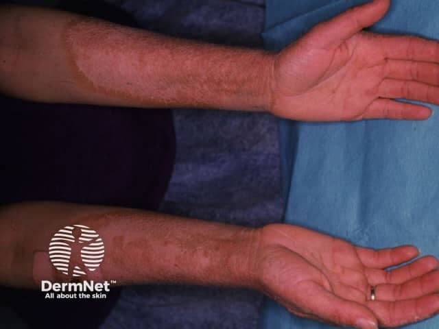 Clinical photography of both forearms demonstrating pellagra dermatitis due to niacin (nicotinamide) deficiency. Imaging modality: standardized dermatologic photography using noninvasive external illumination; views capture the ventral and dorsal surfaces of the bilateral forearms for symmetry assessment. The skin exhibits bilateral, sun-exposed distribution with erythematous, dry, scaly plaques and subtle hyperkeratosis. Lesions are arranged primarily on the extensor aspects of the forearms and dorsum of the hands, with well‑defined margins and occasional superficial desquamation. The texture is rough, with atrophic or macularly pigmented areas where scaling is more prominent; color ranges from erythema to brownish hyperpigmentation. No acute vesiculation is evident. The overall pattern is characteristic of photosensitive dermatitis in nutritional deficiency, supported by accompanying symptoms in typical clinical contexts. Clinically, pellagra dermatitis reflects niacin deficiency and can accompany diarrhea and cognitive changes if untreated. Differential diagnosis includes eczema/atopic dermatitis, contact dermatitis, photodermatoses, and arsenic-related dermatitis; clinical correlation with dietary history, gastrointestinal symptoms, and neurocognitive status is essential. This image serves educational purposes for dermatology and medical education, illustrating classic symmetry, solar-exposed distribution, and coarse keratosis that guide diagnosis and treatment planning with niacin supplementation and dietary modification. Correlation with systemic signs reinforces severity and guides rapid nutritional therapy.