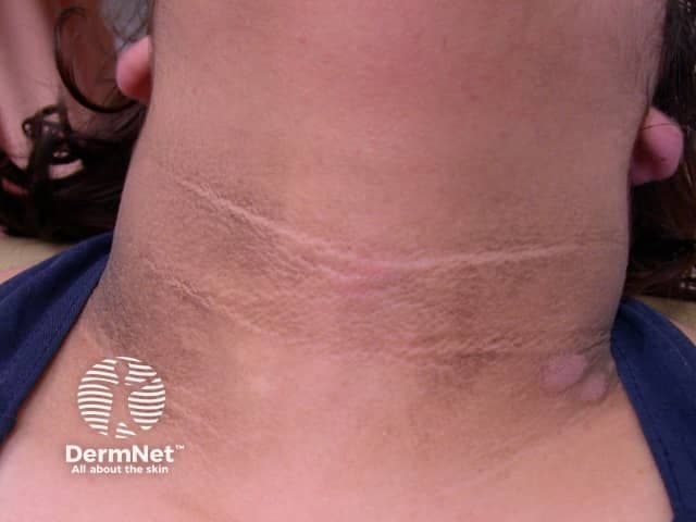 Clinical photography of acanthosis nigricans affecting the anterior neck. Modality: Clinical photography; Technique: close‑up, high‑resolution frontal view of the cervical skin with even illumination. Observed features include diffuse hyperpigmentation and velvety, slightly thickened plaques aligned with neck flexures, most prominent in the anterior cervical region and along the nape-to-thyroid area. Surface texture is smooth to slightly papillomatous with mild pleating; surrounding skin is comparatively lighter. No ulceration, edema, or exudate. The presentation is symmetric and localized to the neck in this image, consistent with classic acanthosis nigricans rather than post‑inflammatory hyperpigmentation alone. Pathophysiology reflects epidermal hyperplasia with papillomatosis and increased melanin deposition in the stratum basale, secondary to insulin resistance–driven growth factor signaling in susceptible individuals. Clinically, acanthosis nigricans serves as a cutaneous marker for metabolic syndrome, obesity, type 2 diabetes mellitus, and less commonly paraneoplastic processes. Differential considerations include frictional dermatitis, dermatitis neglecta, or other causes of hyperpigmented neck plaques. Diagnostic significance lies in prompting metabolic evaluation and search for underlying endocrine or oncologic disease. Useful in dermatology education, primary care triage, and research on cutaneous signs of systemic disease. Correlation with body mass index and fasting glucose improves diagnostic confidence and guides therapeutic lifestyle interventions and monitoring thereafter.