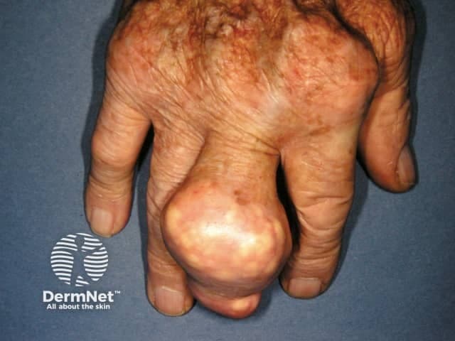 Clinical photography of a left-hand digit showing a gouty tophus. This is a soft-tissue tophus arising from chronic gout with monosodium urate crystal deposition in subcutaneous tissue around the finger joints. The image depicts a single, large, rounded, nodular mass projecting from the dorsal aspect of a finger near the metacarpophalangeal region. The lesion is firm to palpation, with a smooth, pale to whitish surface and surrounding erythema; overlying skin shows mild atrophy and telangiectasia, consistent with chronic inflammatory change. The tophus contains chalky material grossly visible within the dermal and periarticular tissues and may extend toward the joint capsule, eroding adjacent cartilage or bone in long-standing disease. The appearance supports chronic tophaceous gout, though clinical correlation with serum uric acid and prior history of gout is essential. Differential considerations include rheumatoid nodules, xanthomas, and other soft-tissue masses, but the location, size, and chalky appearance strongly favor urate depositions. Diagnostic significance lies in confirming advanced disease with tophus formation; management implications include urate-lowering therapy optimization, anti-inflammatory prophylaxis during flares, and evaluation for additional tophi in other joints. The image is valuable for rheumatology education, dermatology/podiatry teaching, and radiologic-pathologic correlation with ultrasound or dual-energy CT to quantify urate burden.
