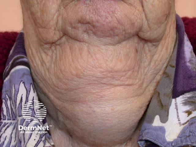 This clinical photograph shows the anterior neck of an adult patient with diffuse thyroid enlargement consistent with goiter. The image modality is clinical photography, captured in a frontal/anterior neck view with the patient seated or standing, natural lighting, and minimal magnification. The thyroid gland is visibly enlarged, producing a prominent cervical contour in the midline and bilateral lobes that extend laterally toward the sternocleidomastoid regions. Skin over the gland is wrinkled and thin, without evident ulceration or focal nodularity on the presented surface; there is modest venous prominence posteriorly. The enlargement appears diffuse rather than a single palpable nodule, suggesting a diffuse goiter or multinodular process that may be chronic. No tracheal deviation or airway compromise is clearly visible in this image, though clinical correlation is necessary to evaluate for compressive symptoms. Clinically, goiter etiologies include iodine deficiency, autoimmune thyroiditis (Hashimoto), Graves disease, or benign/multinodular thyroid neoplasms. Diagnostic significance: clinical confirmation of thyroid enlargement; subsequent assessment should include thyroid function tests (TSH, free T4), thyroid autoantibodies, and high-resolution neck ultrasound or CT/MRI as indicated. Differential considerations include diffuse toxic goiter, thyroiditis, and focal neoplasms. This image is educational for endocrine pathology, ENT, and radiology training, illustrating external thyroid enlargement and its gross appearance in situ.
