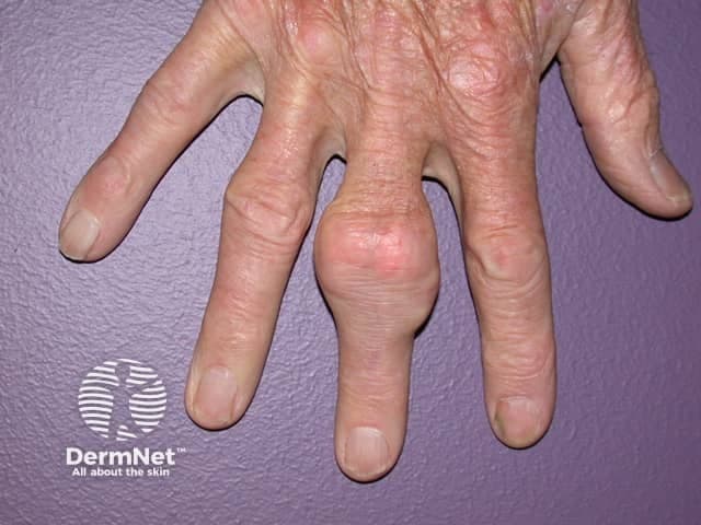 This clinical photograph demonstrates a chronic gout-related tophus involving a finger. Modality: Clinical photography of a human hand. Anatomical location: finger, likely the proximal interphalangeal joint region of the index or middle finger. Appearance: a firm, nodular subcutaneous mass projecting from the dorsal aspect of the finger, about one to two centimeters in diameter, skin overlying the lesion is thin and not broken with mild erythema; the nodule may be slightly lobulated and adherent to underlying structures. Composition: tophus composed of monosodium urate crystals deposited in soft tissue with surrounding granulomatous inflammation; chalky white material can be palpated in some cases. Clinical significance: hallmark of chronic gout; correlates with hyperuricemia and recurrent acute flares; risk of joint destruction if untreated; differential includes rheumatoid nodules, epidermal inclusion cysts, or xanthomas. Diagnostic relevance: supports diagnosis of gout in patients with elevated uric acid; can guide management including urate-lowering therapy, anti-inflammatory treatment, and consideration of imaging such as ultrasound or crystal evaluation. Usage: educational illustration for dermatology, rheumatology, and medical training; useful for patient education on chronic gout and tophi formation, assessment of soft tissue nodules, and monitoring response to therapy. Clinical correlation with gout history strengthens diagnostic confidence; early recognition prevents joint damage and guides urate-targeted therapy outcomes.
