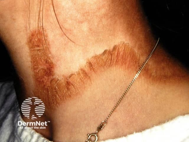 Clinical photograph of the neck showing a circumferential, necklace-like plaque around the posterior and lateral cervical region. The lesion exhibits well-defined borders with thick desquamating scales along the edge and mild erythema, producing a coppery-brown to tan coloration. This Casal necklace sign is a classic cutaneous manifestation described in secondary syphilis and should prompt serologic evaluation for syphilis (non-treponemal tests such as RPR or VDRL, followed by treponemal confirmation). The distribution is circumferential around the neck, forming a collar-like ring with subtle surface scale and no obvious purulence. Surrounding skin appears otherwise normal, and there is no visible edema or multi-lobar involvement; jewelry is present for scale but not implicated in the eruption. The image is a dermatology clinical photograph; no histopathology or contrast imaging is performed. Differential diagnoses include tinea corporis with neck involvement, pityriasis circinata et marginata, granuloma annulare, discoid eczema, and contact dermatitis from jewelry; however, the characteristic ringed, collarette scaling around the neck in this clinical setting strongly supports secondary syphilis. This finding has diagnostic significance for infectious disease and dermatology and emphasizes the need for comprehensive sexual health assessment and potential HIV testing. Clinical correlation with history and serology is essential for management and public health.