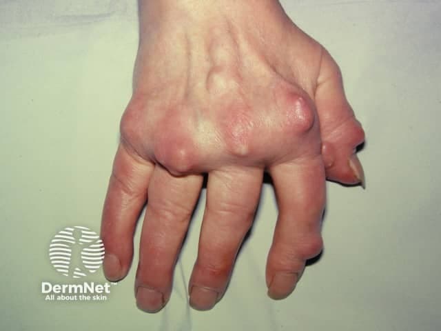 This clinical photograph depicts a dorsal view of the hand with visible gouty tophi over the metacarpophalangeal joints of several digits. The image documents soft tissue nodules characteristic of chronic tophaceous gout. The tophi are subcutaneous, firm masses projecting over the dorsal MCP region, with overlying skin that may appear erythematous or thinned. In advanced disease, chalky white crystalline material may be present within the nodules, reflecting monosodium urate crystal deposition. The distribution is periarticular to the finger joints and may be bilateral and progressive. Pathophysiologically, persistent hyperuricemia promotes MSU crystal deposition with a granulomatous inflammatory response, leading to nodular masses that can cause joint erosion and functional impairment. Clinically, these findings confirm chronic gout and signal high urate burden, risk of joint destruction, and possible renal involvement. This image is educational for rheumatology and dermatology, illustrating cutaneous tophi, aiding differential diagnosis from rheumatoid nodules or xanthomas, and underscoring the role of urate-lowering therapy, diet modification, and renal evaluation. Suitable for medical education, case documentation, and teaching deposition patterns of urate crystals.