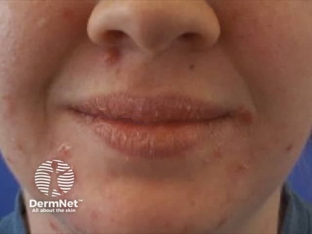 This frontal, close-up clinical photograph depicts the perioral region with multiple reddish papules surrounding the mouth, crusted fissures at the commissures, and mild desquamation of the lips. The vermilion border shows dry, cracked skin with papular lesions at the perioral gingivo-labial junction. There is bilateral involvement around the lips, with a pattern consistent with perioral dermatitis or angular cheilitis. No obvious swelling or mucosal involvement beyond the perioral skin. The skin tone shows mild erythema, dryness, and scaling. The image is captured in standard clinical photography settings with frontal orientation; there is no magnification evidence of dermoscopy. The observed lesions are non-ulcerative, non-vesicular, and present as clustered papules with crusts. The differential includes perioral dermatitis, angular cheilitis, irritant contact dermatitis, seborrheic dermatitis of the perioral region, candidal infection, and less likely herpes simplex infection which would show grouped vesicles. The clinical significance lies in distinguishing inflammatory, infectious, and irritant etiologies to guide therapy: topical antibiotics or antifungals, barrier repair, avoidance of irritants, and consideration of topical steroids in selective cases. This image is appropriate for dermatology education, clinical case discussions, and image-based training. Clinical relevance includes monitoring treatment response progress.