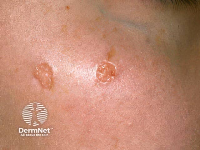 Clinical photograph of two small annular lesions on the zygomatic cheek. The imaging modality is standard color photography used in dermatology to document cutaneous tumors. The primary subject is annular trichoepithelioma, a benign adnexal neoplasm with hair follicle differentiation. The lesions appear as well-circumscribed circular plaques with slightly raised borders and a pale or atrophic center. Skin tone is light to medium; the surface is smooth with minimal scale; surrounding skin is non-inflammatory. The location corresponds to the zygomatic region of the face, within the aesthetic facial unit. The lesions are non-ulcerated, nonpalpable, and asymptomatic with no pigmentary change. Differential diagnosis includes basal cell carcinoma presenting as pearly annular rings, desmoplastic trichoepithelioma, and other adnexal tumors. Clinical significance lies in distinguishing benign trichoepitheliomas from malignant skin cancers to avoid overtreatment; biopsy or dermoscopic assessment may be considered if diagnostic uncertainty persists. This image is valuable for educational purposes, illustrating classic annular morphology and facial localization. Potential clinical use cases include dermatology training, teledermatology, lesion characterization in cutaneous tumor registries, and preoperative planning for excision with cosmetic preservation. No signs of invasion or systemic disease are apparent. Clinical notes recommended. Appropriate for patient counseling, documentation, and surgical planning in clinical practice.
