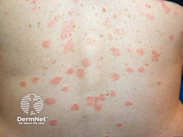 This image depicts a clinical dermatology photograph of the back (posterior trunk) showing multiple erythematous, oval to round plaques characteristic of pityriasis rosea. Acquired in routine outpatient photography, the lesions are salmon-pink to rose-colored, 0.5–2 cm in diameter, with fine, collarette-like scaling at the outer margin and a smooth central surface. The distribution is trunk-predominant with clustering along the spinal regions, consistent with the classic Christmas-tree pattern along skin cleavage lines. The inflammatory plaques may appear slightly raised and may coalesce in areas of friction. No confluent involvement of the face or mucosa is evident. In pityriasis rosea, the eruption often follows a herald patch, though this image focuses on the secondary eruption phase. The differential diagnosis at this stage includes tinea corporis, guttate psoriasis, secondary syphilis, and eczema; however, the sharp, circular to oval morphology, peripheral scaling, and trunk-centric distribution support pityriasis rosea. The clinical significance rests in recognizing its typical self-limited course, usually resolving within several weeks to months and requiring supportive care for itch. This image is relevant for educational demonstrations of PR skin manifestations, photographic recognition in dermatology training, and comparative studies of pityriasis rosea presentations across phototypes. Potential clinical uses include triage, patient education, and dermatologic image search for pattern recognition.