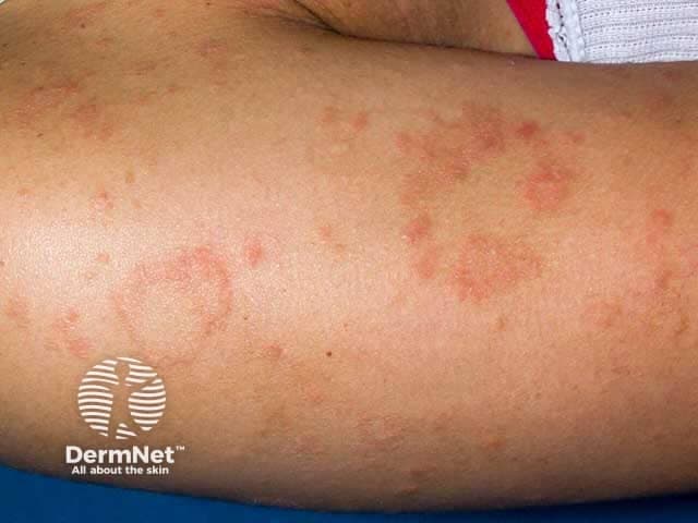 This is a clinical dermatology photograph of in vivo human skin on the forearm, illustrating a herald patch with accompanying pityriasis rosea–type lesions in a patient with skin of color. Imaging modality: clinical photography; technique: standard digital single-shot close-up under diffuse studio lighting or natural daylight. Primary subject: an oval to circular erythematous-to-pink patch with fine peripheral scaling (collarette scale) and slight central clearing, consistent with a herald patch of pityriasis rosea. Surrounding skin shows multiple smaller patches or papules at various stages of eruption, creating a subtle, tree-like distribution that may become more pronounced with trunk involvement in subsequent weeks. In darker phototypes, erythema can be muted, and residual postinflammatory hyperpigmentation may dominate as brown-pigmented patches after resolution. The lesion margins are well defined, the surface may show delicate scale, and there is no vesiculation or crusting observed. The image highlights characteristic pigmentary presentation in skin of color and emphasizes diagnostic cues: herald patch with collarette scaling, annular geometry, and the expected eruption sequence preceding a generalized rash. Clinically, this supports pityriasis rosea over mimics such as tinea corporis, eczema, or psoriasis, and informs patient counseling, prognosis, and follow-up assessment.