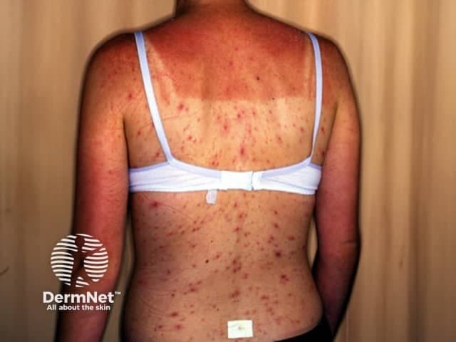 Clinical photography of the patient’s back showing a vesiculo-papular rash consistent with varicella (chickenpox). Modality: clinical dermatology photography; technique: high‑resolution color digital photograph acquired in a clinical setting, posterior/dorsal view of the trunk; lighting: diffuse, even illumination; no contrast. Anatomical context: integumentary system; back (thoracic‑lumbar paraspinal region) with lesions concentrated along the paraspinal and scapular areas. Lesion morphology: crops of small erythematous macules evolving into papules and vesicles, some ruptured with crust formation; surfaces may be dewy and excoriated from scratching; vesicles appear as translucent, fluid‑filled lesions on an inflamed base; color varying from red to pink; distribution: centripetal (trunk > face > limbs) with bilateral symmetry; no mucosal involvement evident in this view; progression stage in this image suggests early-to-mid vesicular phase with healing crusts. Clinical interpretation: rash compatible with varicella infection; differential considerations include disseminated herpes zoster in adults and less likely pityriasis rosea or papular urticaria; diagnostic significance: highly contagious, portal of entry for VZV; clinical correlation: fever, malaise, pruritus; management implications: isolation, antiviral therapy in appropriate populations; educational and research use: dermatology teaching, image-based differential diagnosis, telemedicine consultation. Keywords: varicella, chickenpox, vesicular rash, trunk-dominant eruption, vector contagion, VZV.