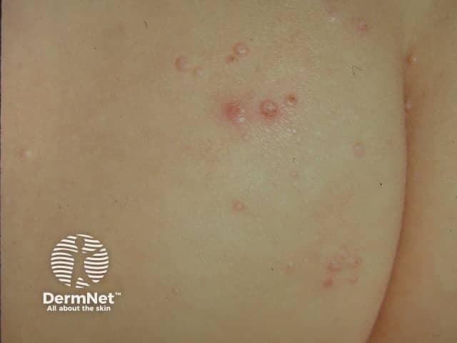 Dermatologic clinical photography capturing multiple molluscum contagiosum lesions on the gluteal skin. Modality: high‑resolution standardized digital photograph in a close‑up frontal view. Subject: human cutaneous tissue; epidermal and superficial dermal involvement. Imaging perspective: surface view of a non‑palpable, dome‑shaped papule cluster with central umbilication. Visual features include flesh‑colored to erythematous, umbilicated papules ranging approximately 2–5 mm in diameter, with smooth, shiny surfaces and a soft, pearly tactile quality. Distribution is localized to a single body region with minimal surrounding erythema; lesions are several in number, arranged in a scattered, clustered pattern typical of pediatric molluscum contagiosum. No surrounding edema or necrosis observed. Histology not available; diagnosis is clinical, supported by characteristic central indentations and fingertip tenderness when manipulated. The image provides rapid educational identification of molluscum contagiosum vs. differential diagnoses such as common warts (HPV), folliculitis, or keratinocyte nevi. Clinical significance includes contagiousness via direct contact and potential spontaneous resolution over months; treatment may be considered for cosmetically conspicuous or symptomatic lesions. Use cases include dermatology teaching, primary care triage, and teledermatology evaluation, with emphasis on recognizing pediatric cutaneous viral infections and communicating uncertainty to patients and caregivers. Document lesion count, distribution, and evolution over time to guide management decisions.