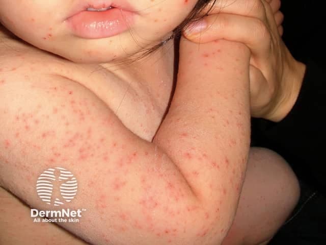 This pediatric dermatology clinical photograph provides a high-resolution, close-up view of a diffuse, non-vesicular erythematous maculopapular eruption on exposed skin surfaces. Lesions are small, round-to-oval papules and flat-topped macules with an erythematous base, distributed across the trunk, proximal limbs, and facial regions (notably the cheek). The pattern includes trunk and limb involvement with milder facial manifestations, and there is no evidence of vesicles, crusts, purpura, or mucosal involvement in the visible fields. The skin shows uniform morphology without scaling or hallmark vesicular halos. Clinically, the image suggests a benign viral exanthem typical of childhood illnesses, such as measles, rubella, roseola, or parvovirus B19, though a non-specific presentation is common. This visualization aids differential diagnosis by contrasting with varicella (vesicles at multiple stages) and hand-foot-mouth disease (palmar/plantar vesicles). Diagnostic significance lies in correlating the rash with febrile or systemic symptoms, exposure history, and vaccination status to guide patient counseling, isolation decisions, and management. Practical educational value includes teaching pediatricians, dermatologists, and infectious disease clinicians about pediatric rash patterns, syndrome-based diagnosis, and telemedicine skin assessments.