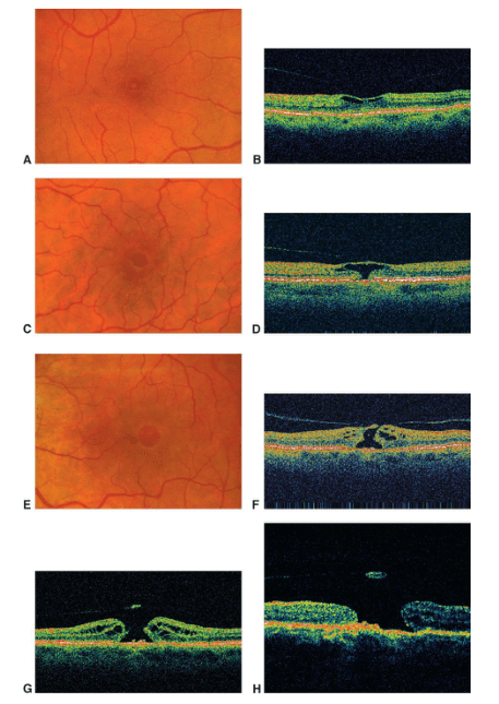 Summary : This figure presents a series of retinal fundus photographs and corresponding optical coherence tomography (OCT) scans, illustrating progressive stages of macular pathology.