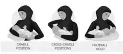 Summary : This illustration demonstrates three common breastfeeding positions used by mothers to hold their infants: cradle position, cross-cradle position, and football hold.
photo:
Scene Overview :
• The image shows three side-by-side illustrations of a mother holding a baby in different breastfeeding positions.
• Each position is labeled below the corresponding illustration: "CRADLE POSITION," "CROSS-CRADLE POSITION," and "FOOTBALL HOLD."
• The mother is depicted wearing a dark, long-sleeved garment and a head covering.
• The baby is held close to the mother's chest in each position.
Technical Details :
• The illustrations are simple, with clear outlines and minimal shading.
• No scale bar, magnification, or technical imaging details are present.
• The background is plain and uncluttered.
Spatial Relationships :
• Left: Cradle position – mother’s arm supports the baby’s head and body, baby lies horizontally across the front.
• Center: Cross-cradle position – mother’s opposite arm supports the baby’s head, with the baby’s body across the front.
• Right: Football hold – mother holds the baby under her arm, with the baby’s body tucked alongside her side.
Analysis :
• The figure visually compares three breastfeeding holds, highlighting differences in arm placement and baby orientation.
• The cradle and cross-cradle positions both involve the baby lying across the mother’s front, but with different supporting arms.
• The football hold positions the baby along the mother’s side, which may be useful for certain feeding situations or comfort preferences.