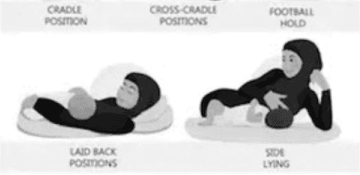 Summary : This illustration demonstrates four common breastfeeding positions for mothers and infants, each labeled with its respective name and depicted with simple, shaded figures.
illustration:
# Breastfeeding Positions :
• Cradle Position: Mother reclined, baby held across her body in a traditional cradle hold.
• Cross-Cradle Position: Mother reclined, baby held across her body with opposite arm supporting the baby.
• Football Hold: Mother seated, baby tucked under her arm at her side, similar to holding a football.
• Side Lying: Mother and baby both lying on their sides facing each other.
# Labels & Layout :
• Top row: Position names—Cradle Position, Cross-Cradle Positions, Football Hold.
• Bottom row: Laid Back Positions (left), Side Lying (right).
• Each position is visually separated and clearly labeled above or below the corresponding illustration.
# Scene Overview :
• Simple, monochrome drawing style.
• Figures are shown on soft surfaces (pillows or mats).
• No background details; focus is on body posture and baby placement.
# Spatial Relationships :
• Left side: Laid back positions (mother reclined, baby on chest).
• Right side: Side lying (mother and baby parallel on their sides).
• Each position demonstrates a different angle and arm placement for supporting the baby.
Analysis :
• The figure provides a clear visual comparison of four distinct breastfeeding positions, highlighting differences in body orientation and arm support. It serves as an educational guide for mothers to choose a comfortable and effective feeding posture.