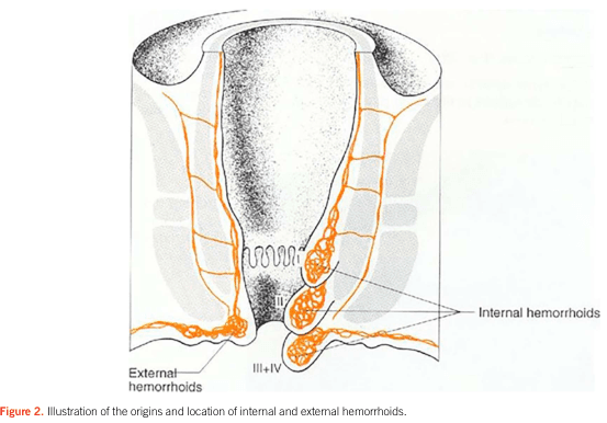 Summary : This illustration shows the anatomical origins and locations of internal and external hemorrhoids in relation to the anal canal and rectum.
illustration:
# Scene Overview :
• Main subject is a cross-sectional anatomical diagram of the lower rectum and anal canal.
• The image highlights the positions of internal and external hemorrhoids using orange outlines.
• The anal canal is centrally depicted, with the rectum above and the perianal skin below.
# Technical Details :
• Internal hemorrhoids are shown as bulging structures within the anal canal, above the dentate line.
• External hemorrhoids are depicted as bulges below the dentate line, near the anal verge.
• Labels indicate "Internal hemorrhoids" and "External hemorrhoids" with arrows pointing to their respective locations.
• The illustration includes reference to hemorrhoid grades (III, III+IV) near the anal opening.
# Spatial Relationships :
• Internal hemorrhoids are located higher up within the anal canal, above the dentate line.
• External hemorrhoids are situated outside or below the anal canal, near the skin surface.
• The diagram provides a clear distinction between the two types based on their anatomical position.
# Analysis :
• The figure visually clarifies the difference in origin and location between internal and external hemorrhoids, emphasizing their anatomical separation by the dentate line. Internal hemorrhoids are positioned within the anal canal, while external hemorrhoids are found at or below the anal verge.