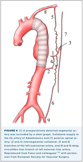 Summary : This is a medical illustration showing the anatomy of the thoracic and abdominal aorta, with a stent graft in place, and the collateral arterial supply to the spinal cord. The diagram is annotated with numbered arteries and collateral pathways, referencing their anatomical names and clinical significance.
illustration:
# Scene Overview :
• Main subject: The thoracic and abdominal aorta, with a stent graft placed in the descending thoracic aorta.
• Perspective: Sagittal (side) view of the aorta and its major branches.
• Composition: The aorta is centrally depicted, with collateral arteries and spinal cord shown to the right.
• Colour palette: Red for arteries, grey for stent graft, black for annotation numbers and lines.
# Technical Details :
• Stent graft: Shown as a grey, zigzag-patterned tube within the descending thoracic aorta.
• Numbered arteries:
– 1: Preoperatively detected segmental artery (occluded by stent graft).
– 2, 4: Intersegmental collateral arteries.
– 3: Artery of Adamkiewicz.
– 5, 8: Branches of the left subclavian artery.
– 6, 9: Deep circumflex iliac branch of left external iliac artery.
– 7: Anterior spinal artery.
• Collateral pathways: Wavy lines connecting the aorta to the spinal cord, indicating alternate blood supply routes.
# Spatial Relationships :
• The stent graft is placed in the upper descending thoracic aorta, occluding the segmental artery (1).
• Collateral arteries (2, 4, 5, 6, 8, 9) are shown branching from the aorta and iliac arteries, connecting to the spinal cord.
• The artery of Adamkiewicz (3) and anterior spinal artery (7) are highlighted as key vessels for spinal cord perfusion.
# Analysis :
• The illustration emphasizes the importance of collateral circulation to the spinal cord when a segmental artery is occluded by a stent graft.
• Multiple collateral pathways are depicted, suggesting redundancy in spinal cord blood supply.
• The diagram is useful for understanding vascular anatomy relevant to aortic stent grafting and spinal cord protection.
