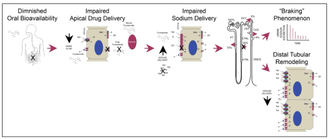 Summary : This figure illustrates the sequential mechanisms underlying diuretic resistance, specifically focusing on furosemide, from diminished oral bioavailability to distal tubular remodeling and the "braking" phenomenon in the nephron.
flowchart:
# Nodes :
• Diminished Oral Bioavailability (text, human outline with stomach marked, furosemide molecule, downward arrow for urine flow)
• Impaired Apical Drug Delivery (rectangular cell diagram, furosemide molecules, albumin, Na+ and K+ channels, blocked delivery indicated)
• Impaired Sodium Delivery (rectangular cell diagram, furosemide, Na+ and K+ channels, blocked sodium delivery)
• "Braking" Phenomenon (nephron schematic, percentage sodium reabsorption at different segments: PT 70%, TAL 20%, DCT 7%, CCD 5%; small line graph showing decrease in sodium excretion over time)
• Distal Tubular Remodeling (rectangular cell diagrams, increased sodium delivery, altered channel expression)
# Connectors :
• Arrows connect each node in left-to-right sequence, indicating progression of mechanisms.
• Each arrow is solid and points to the next step in the process.
# Layout :
• Linear, left-to-right arrangement.
• Each node is visually separated and contains both text and schematic/chemical illustrations.
• The nephron schematic is centrally placed, with percentages and segment labels (PT, TAL, CTAL, DCT, CCD, OMCD, CN).
# Analysis :
• The flowchart demonstrates a stepwise progression: initial reduction in oral bioavailability leads to impaired drug delivery at the apical membrane, which then causes impaired sodium delivery in the nephron. This results in the "braking" phenomenon, where sodium excretion decreases over time, and ultimately leads to distal tubular remodeling with altered sodium channel expression. The figure visually links each mechanism, highlighting how resistance to diuretics develops through multiple renal and pharmacokinetic adaptations.