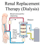Summary : This illustration explains the process of renal replacement therapy (dialysis), showing how blood is removed from the body, cleansed in a dialyzer, and then returned.
illustration:
# Scene Overview :
• Main subject is a schematic diagram of dialysis treatment.
• Shows a human arm with blood vessels connected to a dialysis circuit.
• The circuit includes a dialyzer (depicted as a cylindrical device) and a machine.
# Technical Details :
• Labels: "Blood removed for cleansing", "Dialyzer", "Clean blood returned to the body".
• Blood flow is indicated by colored arrows: red (blood out), blue (clean blood in), yellow (waste removal).
• The dialyzer is shown with internal layers, suggesting filtration.
# Spatial Relationships :
• Blood is drawn from the arm, passes through tubing to the dialyzer, then returns to the arm.
• Waste products exit the dialyzer to a separate container/machine.
# Analysis :
• The diagram visually clarifies the dialysis process: blood is removed, filtered, and returned, with waste separated out. The flow is unidirectional and cyclical, emphasizing the cleansing function of the dialyzer in renal replacement therapy.