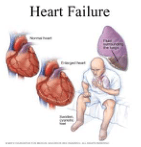 Summary : This medical illustration explains heart failure by comparing a normal heart to an enlarged heart, showing associated symptoms and complications.
photo:
Scene Overview :
• The main subjects are two anatomical heart diagrams (normal and enlarged), a diagram of a lung with fluid, and a person sitting on a bed appearing short of breath.
• The illustration uses a mix of realistic and schematic styles, with red and brown tones for the hearts, purple for the lung, and a pale blue/white background.
• The person is depicted holding their chest and breathing with difficulty, suggesting distress.
Technical Details :
• Labels identify “Normal heart,” “Enlarged heart,” “Swollen, cyanotic feet,” and “Fluid surrounding the lungs.”
• The heart diagrams show the normal heart as smaller and the enlarged heart as larger and more rounded.
• The lung diagram highlights fluid accumulation around the lungs.
• The person’s feet are shown as swollen and cyanotic (bluish), indicating poor circulation.
Spatial Relationships :
• The normal and enlarged hearts are placed side by side for direct comparison.
• The lung diagram is positioned above and to the right, with a label pointing to the fluid.
• The person is seated in the foreground, with visual emphasis on their feet and facial expression.
Analysis :
• The figure visually communicates that heart failure leads to an enlarged heart, fluid buildup around the lungs, and swelling/cyanosis in the feet, resulting in difficulty breathing and physical distress.