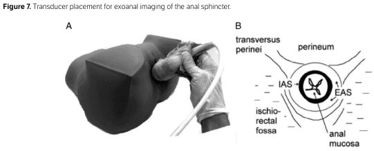 Summary : This figure demonstrates the placement of an ultrasound transducer for exoanal imaging of the anal sphincter, including both a photographic representation and a schematic cross-sectional diagram of the relevant anatomy.
photo and anatomical diagram:
# Panel A : Transducer Placement Photo
• Shows a gloved hand holding an ultrasound transducer.
• The transducer is positioned externally against the anal region of a model or patient.
• The hand and transducer are oriented perpendicular to the anal opening.
• The image is in grayscale, with clear focus on the transducer’s contact with the skin.
# Panel B : Cross-sectional Anal Anatomy Diagram
• Circular schematic cross-section of the anal region.
• Labeled structures:
– transversus perinei (top left)
– perineum (top right)
– ischiorectal fossa (bottom left)
– anal mucosa (bottom right)
– IAS (internal anal sphincter, inner ring)
– EAS (external anal sphincter, outer ring)
• The anal canal is depicted centrally, with arrows indicating the orientation of the sphincters.
• Surrounding lines represent tissue layers and anatomical boundaries.
# Spatial Relationships :
• Panel A shows the real-world placement of the transducer, while Panel B provides anatomical context for the imaging plane.
• The transducer is placed externally, targeting the sphincter complex as shown in the diagram.
# Analysis :
• The figure clarifies the correct external placement of the ultrasound transducer for imaging the anal sphincter.
• The schematic highlights the anatomical structures visualized in this imaging approach, including both the internal and external anal sphincters and adjacent tissues.
• The combination of photo and diagram aids in understanding both technique and anatomical targets for exoanal ultrasound.
