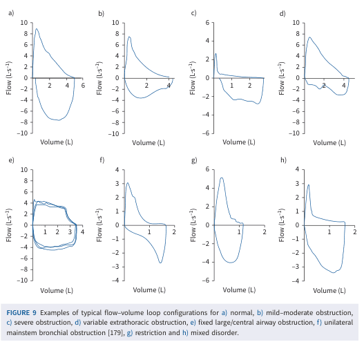 Summary : This figure presents eight typical flow–volume loop configurations, each illustrating a different pattern of pulmonary function abnormality, including normal, obstructive, restrictive, and mixed disorders.
flow–volume loop plots:
# Title & Axes :
• Figure title: "Examples of typical flow–volume loop configurations for a) normal, b) mild–moderate obstruction, c) severe obstruction, d) variable extrathoracic obstruction, e) fixed large/central airway obstruction, f) unilateral mainstem bronchial obstruction, g) restriction and h) mixed disorder."
• X-axis: "Volume (L)" with tick labels ranging from 0 to 6 (varies by panel).
• Y-axis: "Flow (L·s⁻¹)" with tick labels ranging from -10 to 10 (varies by panel).
# Panels & Data Points :
• Panel a) Normal: Loop with peak expiratory flow near 10 L·s⁻¹, volume up to ~6 L, smooth descending limb.
• Panel b) Mild–moderate obstruction: Lower peak flow (~8 L·s⁻¹), volume up to ~4 L, scooped-out descending limb.
• Panel c) Severe obstruction: Peak flow ~6 L·s⁻¹, volume up to ~2.5 L, pronounced scooping and reduced flow.
• Panel d) Variable extrathoracic obstruction: Peak flow ~6 L·s⁻¹, volume up to ~4 L, plateau in inspiratory limb.
• Panel e) Fixed large/central airway obstruction: Loops with both inspiratory and expiratory plateaus, volume up to ~4 L, flow range -8 to 8 L·s⁻¹.
• Panel f) Unilateral mainstem bronchial obstruction: Peak flow ~3 L·s⁻¹, volume up to ~2 L, irregular loop shape.
• Panel g) Restriction: Peak flow ~6 L·s⁻¹, volume up to ~2 L, steep and narrow loop.
• Panel h) Mixed disorder: Peak flow ~4 L·s⁻¹, volume up to ~2 L, combination of scooping and restriction features.
# Design Encodings :
• Each panel shows a single blue line representing the flow–volume loop.
• Axes are consistent in style, with horizontal and vertical grid lines.
• No additional colour or marker encodings.
# Distribution & Trends :
• Normal loop (a) is tall and broad, with a rapid rise and gradual fall.
• Obstructive loops (b, c) show reduced peak flow and scooped-out descending limbs.
• Restrictive loop (g) is narrow and steep, with reduced volume.
• Fixed obstruction (e) shows plateaus in both inspiratory and expiratory limbs.
• Mixed disorder (h) combines features of obstruction and restriction.
# Analysis :
• The figure visually distinguishes between normal, obstructive, restrictive, and mixed pulmonary function patterns.
• Obstructive patterns are characterised by reduced peak flow and scooping; restrictive patterns by reduced volume and steep loops.
• Fixed and variable obstructions show plateaus, while mixed disorders combine features.
• These loop shapes are diagnostic for different types of airway and lung pathology.