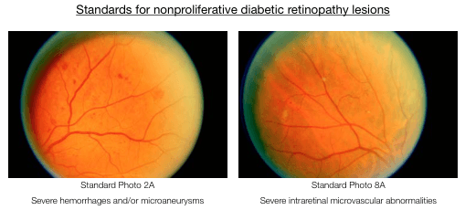 Summary : This figure presents two standard retinal photographs used to define nonproliferative diabetic retinopathy lesions, specifically severe hemorrhages/microaneurysms and severe intraretinal microvascular abnormalities.