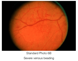 Summary : This image shows a retinal photograph demonstrating severe venous beading, used as a standard reference in ophthalmology.