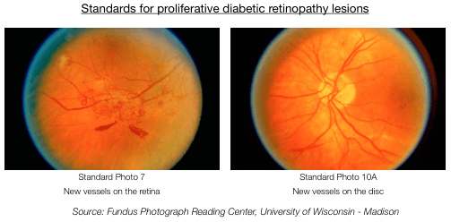 Summary : This figure presents standard fundus photographs used to identify proliferative diabetic retinopathy lesions, specifically highlighting new vessel formation on the retina and optic disc.