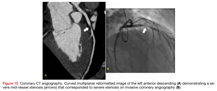 Summary : This figure presents two imaging modalities used to assess coronary artery disease, specifically showing a severe mid-vessel stenosis in the left anterior descending artery. The left panel (A) is a coronary CT angiography image, and the right panel (B) is an invasive coronary angiography image. Both images use arrows to indicate the location of the stenosis.