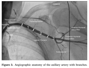 Summary : This figure presents an angiographic image showing the anatomy of the axillary artery and its branches, with clear labeling of major arteries and anatomical landmarks in the shoulder and upper chest region.
photo:
Scene Overview :
• Main subject is the axillary artery and its branches, visualized via angiography in the upper thorax and shoulder region.
• Perspective is anteroposterior, showing the left side of the chest and shoulder.
• Black-and-white contrast typical of angiographic imaging.
Technical Details :
• On-image labels identify key arteries: Subclavian, LIMA (Left Internal Mammary Artery), Vertebral, Thyrocervical, Thoracoacromial, Lateral Thoracic, Subscapular, Anterior Humeral Circumflex, Posterior Humeral Circumflex.
• Anatomical landmark "Coracoid" is labeled.
• The axillary artery is divided into three numbered segments (1, 2, 3) along its course.
• No scale bar or magnification is provided.
Spatial Relationships :
• The subclavian artery transitions into the axillary artery, which is divided into three segments.
• Branches arise from each segment:
– Segment 1: Thoracoacromial branch.
– Segment 2: Lateral thoracic branch.
– Segment 3: Subscapular, anterior humeral circumflex, and posterior humeral circumflex branches.
• The LIMA and vertebral arteries are shown branching proximally from the subclavian artery.
Analysis :
• The image clearly delineates the branching pattern of the axillary artery, with each major branch labeled and spatially related to the three anatomical segments.
• The figure is useful for understanding vascular anatomy relevant to surgical or interventional procedures in the shoulder and upper chest.