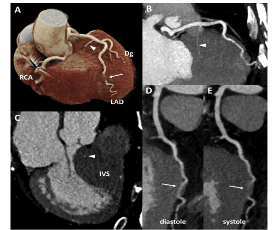 Summary : This figure presents multiple cardiac CT images illustrating the anatomy and course of the coronary arteries, with specific attention to the left anterior descending artery (LAD), right coronary artery (RCA), and their relationship to the interventricular septum (IVS) during different phases of the cardiac cycle.
photo:
# Cardiac Anatomy Overview :
• Panel A shows a 3D reconstructed cardiac CT image highlighting the RCA, LAD, and a diagonal branch (Dg).
• The LAD is traced along the anterior surface of the heart, with a white arrow indicating its course.
• The RCA is visible on the right side of the heart.
• A white arrowhead marks a specific anatomical point on the LAD.
# Coronary Artery Course :
• Panel B displays a curved multiplanar reconstruction of the LAD, with a white arrowhead indicating a notable segment.
• The LAD is seen running along the anterior interventricular groove.
# Interventricular Septum (IVS) Relationship :
• Panel C shows a cross-sectional CT image of the heart, with the IVS labeled.
• The white arrowhead points to the LAD as it courses over the IVS.
# Cardiac Cycle Phases :
• Panels D and E compare the LAD's appearance during diastole and systole.
• Both panels show the LAD (white arrows) in similar anatomical positions, but the surrounding cardiac structures differ due to the phase of the cardiac cycle.
# Technical Details :
• Images are grayscale except for the 3D reconstruction in panel A, which uses color to differentiate anatomical structures.
• No scale bars or magnification details are provided.
• Labels include RCA (right coronary artery), LAD (left anterior descending artery), Dg (diagonal branch), and IVS (interventricular septum).
# Spatial Relationships :
• The LAD is consistently shown on the anterior surface of the heart, running parallel to the IVS.
• The RCA is positioned on the right side of the heart.
• The anatomical course of the LAD is compared across different imaging planes and cardiac phases.
# Analysis :
• The figure demonstrates the anatomical course of the LAD and its relationship to the IVS, as well as the consistency of its position during diastole and systole.
• The use of multiple imaging planes and 3D reconstruction provides a comprehensive view of coronary artery anatomy.
• No obvious anomalies or pathologies are visible in the presented images.