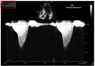 Summary : This image shows a continuous wave (CW) Doppler echocardiography tracing during a Valsalva maneuver, used to assess blood flow velocity and pressure gradients across a cardiac valve, likely for evaluating valvular stenosis or regurgitation.
echocardiography Doppler tracing:
# Scene Overview :
• Main subject: CW Doppler spectral display of blood flow velocity over time.
• Setting: Cardiac ultrasound (echocardiography) with a small B-mode image of the heart at the top.
• Perspective: Standard clinical display, black background, white Doppler envelope.
• Colour palette: Black, white, yellow, green, and red overlays for measurements.
# Technical Details :
• Measurement box (top left):
– v: 5.26 m/s (velocity)
– p: 110.59 mmHg (pressure gradient)
• Label: "CW Valsalva Maneuver" (top right, yellow text).
• Y-axis: Velocity (m/s), ranging approximately from -6 to +6 m/s.
• X-axis: Time (seconds), with tick marks at -2.0, -1.5, -1.0, -0.5, 0.0.
• Heart rate (HR): 59 bpm (bottom right).
• ECG trace: Present at the bottom of the display.
• B-mode cardiac image: Small, top center, showing the ultrasound probe position.
# Spatial Relationships :
• Doppler envelope: Two prominent, dense white signals indicating high-velocity flow events.
• Envelope shape: Parabolic, with peak velocities at the center of each event.
• B-mode image: Provides anatomical reference for Doppler sample location.
# Analysis :
• The Doppler tracing shows two high-velocity flow events, each peaking at approximately 5.26 m/s, corresponding to a calculated pressure gradient of 110.59 mmHg.
• The Valsalva maneuver is being performed, as indicated by the label, which may be used to assess dynamic changes in flow or gradients.
• The high velocities and pressure gradient suggest significant valvular stenosis or regurgitation, but the exact diagnosis depends on clinical context.
• The tracing is regular, with no visible arrhythmias or irregularities in the Doppler envelope.