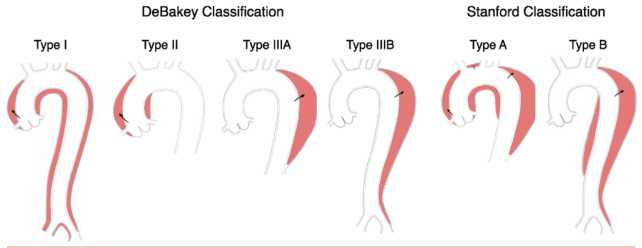 Summary : This illustration compares the DeBakey and Stanford classification systems for aortic dissection, showing the anatomical extent of each type using schematic diagrams of the aorta.
illustration:
# DeBakey Classification :
β’ Type I: Dissection originates in the ascending aorta and extends beyond the aortic arch, often into the descending aorta.
β’ Type II: Dissection is confined to the ascending aorta only.
β’ Type IIIA: Dissection originates in the descending aorta and is limited to the thoracic aorta above the diaphragm.
β’ Type IIIB: Dissection originates in the descending aorta and extends below the diaphragm.
# Stanford Classification :
β’ Type A: Involves the ascending aorta, regardless of the site of origin; includes DeBakey Types I and II.
β’ Type B: Involves only the descending aorta, without involvement of the ascending aorta; includes DeBakey Type III.
# Visual Encodings :
β’ Red shading highlights the affected segments of the aorta for each classification type.
β’ Black arrows indicate the origin or extent of the dissection in each schematic.
β’ The aorta is depicted as a simplified white tube with major branches at the top.
# Layout :
β’ DeBakey types (I, II, IIIA, IIIB) are shown in sequence from left to right, followed by Stanford types (A, B) on the right.
β’ Each type is labeled above its corresponding schematic.
# Analysis :
β’ The DeBakey system subdivides dissections based on both origin and extent, while the Stanford system groups them by involvement of the ascending aorta.
β’ Stanford Type A encompasses more anatomical territory (all cases with ascending aorta involvement), while Type B is restricted to the descending aorta.
β’ The visual comparison clarifies how DeBakey Types I and II map to Stanford Type A, and DeBakey Type III maps to Stanford Type B.