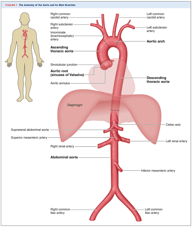 Summary : This figure illustrates the anatomy of the human aorta and its main branches, showing their spatial relationships to major organs and anatomical landmarks.
illustration:
# Main Structures :
• The aorta is depicted as a large, central red vessel running vertically through the torso.
• The aorta is divided into three main sections: ascending thoracic aorta, aortic arch, descending thoracic aorta, and abdominal aorta.
• The diaphragm is shown as a translucent pink structure crossing the aorta.
# Branches and Landmarks :
• Ascending thoracic aorta: arises from the heart, includes the aortic root (sinuses of Valsalva) and aortic annulus.
• Aortic arch: gives rise to three major branches:
– Innominate (brachiocephalic) artery
– Left common carotid artery
– Left subclavian artery
– Right common carotid artery and right subclavian artery branch from the innominate artery.
• Descending thoracic aorta: continues downward through the chest.
• Abdominal aorta: begins below the diaphragm and gives rise to several branches:
– Celiac axis
– Suprarenal abdominal aorta
– Superior mesenteric artery
– Right and left renal arteries
– Inferior mesenteric artery
– Right and left common iliac arteries (terminal branches)
# Spatial Relationships :
• The aorta passes posterior to the heart and anterior to the vertebral column.
• The diaphragm separates the thoracic and abdominal portions of the aorta.
• The abdominal aorta lies centrally and bifurcates into the right and left common iliac arteries at its lower end.
# Annotations and Labels :
• Each major branch and anatomical landmark is clearly labeled with leader lines.
• A small human figure at left shows the aorta’s position within the body.
# Analysis :
• The figure provides a comprehensive overview of the aorta’s anatomy, highlighting its major branches and their order from the heart to the lower abdomen.
• The spatial arrangement clarifies the transition from thoracic to abdominal aorta at the diaphragm.
• The branching pattern demonstrates the aorta’s role as the main conduit for arterial blood from the heart to the rest of the body.