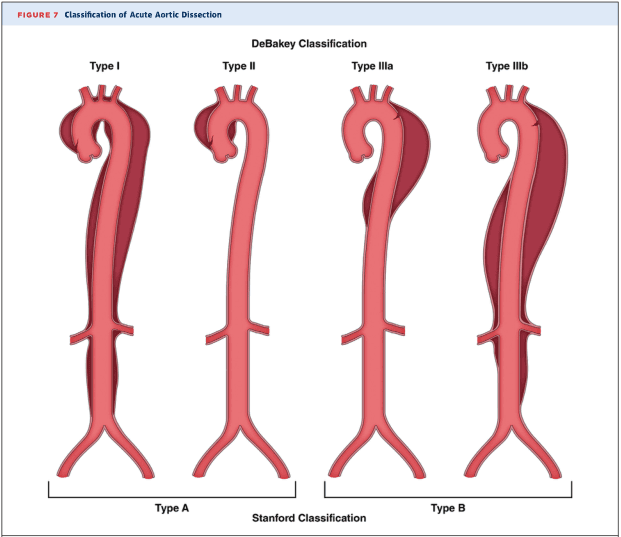 Diagnosis and Management of Aortic Disease