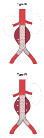 Summary : This figure illustrates two types of endoleaks (Type Ib and Type IV) following endovascular aneurysm repair (EVAR), showing the anatomical locations and flow patterns of each type in relation to the aortic stent graft and aneurysm sac.