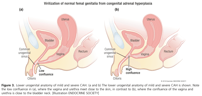 Summary : This figure illustrates the anatomical differences in lower urogenital anatomy between mild and severe cases of congenital adrenal hyperplasia (CAH), focusing on the virilization of normal female genitalia. Two cross-sectional diagrams compare "low confluence" and "high confluence" of the vagina and urethra.