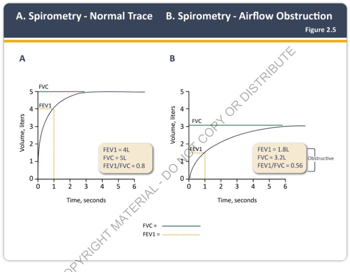 Summary : This figure compares spirometry traces between a normal individual and one with airflow obstruction, illustrating differences in forced expiratory volume in 1 second (FEV1), forced vital capacity (FVC), and the FEV1/FVC ratio.
line plot:
# Title & Axes :
• Title: "A. Spirometry - Normal Trace" and "B. Spirometry - Airflow Obstruction" (Figure 2.5).
• X-axis: "Time, seconds" (range: 0 to 6).
• Y-axis: "Volume, liters" (range: 0 to 5).
• Two panels: A (Normal Trace) and B (Airflow Obstruction).
# Data Points :
## Panel A (Normal Trace) :
• FEV1 = 4L (volume exhaled in first second).
• FVC = 5L (total forced vital capacity).
• FEV1/FVC = 0.8.
• Curve rises steeply in first second, then plateaus near 5L.
• FEV1 marked with a vertical dashed line at 1 second, horizontal at 4L.
• FVC marked with a horizontal line at 5L.
## Panel B (Airflow Obstruction) :
• FEV1 = 1.8L.
• FVC = 3.2L.
• FEV1/FVC = 0.56.
• Curve rises slowly, plateaus near 3.2L.
• FEV1 marked with a vertical dashed line at 1 second, horizontal at 1.8L.
• FVC marked with a horizontal line at 3.2L.
• "Obstructive" label at plateau.
# Design Encodings :
• FVC shown as a solid green horizontal line.
• FEV1 shown as a dashed orange vertical and horizontal line at 1 second.
• Volume-time curves: solid blue lines.
• Beige annotation boxes with FEV1, FVC, and FEV1/FVC values.
• Panel labels: "A" (left), "B" (right).
# Distribution & Trends :
• Panel A: Rapid rise in volume, high FEV1 and FVC, FEV1/FVC ratio within normal range.
• Panel B: Slower rise, lower FEV1 and FVC, reduced FEV1/FVC ratio indicating obstruction.
# Analysis :
• The normal trace (Panel A) shows efficient, rapid exhalation with a high FEV1/FVC ratio (0.8).
• The obstructive trace (Panel B) demonstrates impaired airflow, with a much lower FEV1 (1.8L) and FEV1/FVC ratio (0.56), consistent with obstructive lung disease.
• The difference in curve shapes and ratios visually highlights the diagnostic utility of spirometry in distinguishing normal from obstructive patterns.