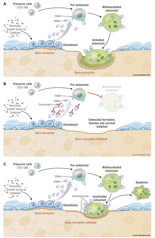 Summary : This figure illustrates the cellular mechanisms of bone formation and resorption, and the effects of two classes of drugs (denosumab and bisphosphonates) on osteoclast development and activity. It is divided into three panels (A, B, C) showing normal physiology, denosumab action, and bisphosphonate action, respectively.
process diagram:
# Panel A: Normal Bone Remodeling :
• Precursor cells (CFU-GM) differentiate into pre-osteoclasts under the influence of hormones, growth factors, and cytokines.
• Osteoblasts produce RANKL, which binds to RANK on pre-osteoclasts, promoting their maturation into multinucleated osteoclasts.
• Activated osteoclasts resorb bone, while osteoblasts form bone, maintaining bone homeostasis.
# Panel B: Denosumab Action :
• Denosumab (depicted as Y-shaped antibodies) binds to RANKL, preventing its interaction with RANK on pre-osteoclasts.
• This inhibits the formation, function, and survival of osteoclasts (multinucleated osteoclast faded out).
• Bone resorption is inhibited, while bone formation by osteoblasts continues.
# Panel C: Bisphosphonate Action :
• Precursor cells and RANKL-RANK signaling proceed as in normal physiology, allowing osteoclast formation.
• Bisphosphonate (depicted as pink triangles) acts on activated osteoclasts, inactivating them and inducing apoptosis.
• Inactivated osteoclasts cannot resorb bone, and apoptotic osteoclasts are removed.
• Bone resorption is inhibited, while bone formation by osteoblasts continues.
# Nodes :
• Precursor cells (CFU-GM) (circle)
• Pre-osteoclast (circle)
• Multinucleated osteoclast (large circle with nuclei)
• Activated osteoclast (large cell with ruffled border)
• Inactivated osteoclast (large cell, faded)
• Apoptosis (fragmented cell)
• Osteoblasts (row of blue cells)
• Hormones, growth factors, cytokines (colored dots)
• RANK/RANKL (small squares)
• Denosumab (Y-shaped antibodies)
• Bisphosphonate (pink triangles)
# Connectors :
• Arrows show differentiation from precursor to pre-osteoclast to multinucleated osteoclast.
• RANKL arrows from osteoblasts to pre-osteoclasts.
• In panel B, red inhibitory line from pre-osteoclast to multinucleated osteoclast.
• In panel C, arrow from bisphosphonate to activated osteoclast, then to inactivated osteoclast and apoptosis.
# Layout :
• Each panel is arranged horizontally: precursor cells on the left, osteoblasts at the bone surface, osteoclast lineage above the bone, and bone formation/resorption processes below.
• Drug actions are superimposed on the normal pathway in panels B and C.
# Analysis :
• The figure demonstrates that normal bone remodeling involves a balance between osteoblast-mediated bone formation and osteoclast-mediated bone resorption.
• Denosumab inhibits osteoclast formation by blocking RANKL, preventing bone resorption.
• Bisphosphonates inactivate and induce apoptosis in mature osteoclasts, also inhibiting bone resorption.
• Both drugs preserve bone formation while reducing bone loss, but act at different stages of the osteoclast lifecycle.