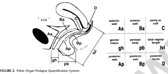 Summary : This figure illustrates the Pelvic Organ Prolapse Quantification (POP-Q) System, showing anatomical landmarks and measurement points used to assess pelvic organ prolapse in women. It includes a labeled sagittal diagram of the female pelvis and a corresponding table summarizing the anatomical sites and their abbreviations.
illustration:
# Sagittal Diagram :
• Depicts the female pelvis in sagittal section, showing the vagina, cervix, bladder, and rectum.
• Key anatomical landmarks are labeled: Aa, Ba, C, D, Ap, Bp, gh, pb, tvl.
• Measurement lines and distances are indicated, such as a 3 cm segment and the total vaginal length (tvl).
• The diagram shows the anterior and posterior vaginal walls, genital hiatus, perineal body, and posterior fornix.
# Table of Measurement Points :
• Lists abbreviations and their corresponding anatomical sites:
– Aa: anterior wall
– Ba: anterior wall
– C: cervix or cuff
– gh: genital hiatus
– pb: perineal body
– tvl: total vaginal length
– Ap: posterior wall
– Bp: posterior wall
– D: posterior fornix
• Table is organized by anatomical region (anterior wall, posterior wall, etc.).
# Technical Details :
• No scale bar, but a 3 cm reference is shown on the diagram.
• All labels are clear and correspond to standard POP-Q terminology.
• The figure is black-and-white, schematic, and designed for educational/clinical reference.
# Spatial Relationships :
• The diagram shows the spatial arrangement of the vagina, cervix, and surrounding structures.
• Measurement points are distributed along the vaginal walls and perineal body.
• The table provides a cross-reference for each labeled point in the diagram.
Analysis :
• The figure provides a comprehensive visual guide to the POP-Q system, clarifying the location and meaning of each measurement point.
• The combination of diagram and table enables accurate identification and quantification of pelvic organ prolapse sites.
• No data trends or anomalies are present; the figure is purely anatomical and instructional.