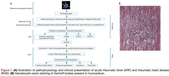 Summary : This figure illustrates the pathophysiology and clinical presentation of acute rheumatic fever (ARF) and rheumatic heart disease (RHD), and shows a histological image of Aschoff bodies in myocardium.
flowchart and photo:
# Panel A: Pathophysiology and Clinical Presentation Flowchart
## Nodes :
• Streptococcus pyogenes infection (text node)
• Tonsillopharyngitis (rectangle)
• Antibody develops to molecules in bacterial group A carbohydrate or streptococcal M protein (rectangle)
• Antibody recognizes same molecules present on the heart, brain, joints and/or skin in susceptible host (rectangle)
• Infiltration of autoreactive T cells and inflammation (rectangle)
• Erythema marginatum, Subcutaneous nodules (rectangle, branch)
• Carditis (rectangle, branch)
• Chorea (rectangle, branch)
• Arthritis (rectangle, branch)
• Valvulitis (rectangle)
• Autoreactive T cells continually activated by cardiac proteins that serve as antigens (rectangle)
• Chronic inflammatory response to cardiac tissue (rectangle)
• Valvular stenosis and regurgitation (rectangle)
• Cardiac chamber dilation (rectangle, branch)
• Pulmonary hypertension (rectangle, branch)
• Arrhythmia (rectangle, branch)
• Heart failure (rectangle, branch)
## Connectors :
• Linear downward arrows connect each main step.
• Branching arrows from "Infiltration of autoreactive T cells and inflammation" to four clinical features: erythema marginatum/subcutaneous nodules, carditis, chorea, arthritis.
• Branching arrows from "Valvular stenosis and regurgitation" to four complications: cardiac chamber dilation, pulmonary hypertension, arrhythmia, heart failure.
## Layout :
• Vertical, left-to-right flow with two main phases: ARF (2–4 weeks) and RHD (years).
• Branches at clinical presentation and complications.
• Timeline markers on the right: "2–4 weeks" for ARF, "Years" for RHD.
# Panel B: Histological Image
## Scene Overview :
• Main subject: Myocardial tissue section stained with hematoxylin-eosin.
• Central focus: Cluster of cells (Aschoff body) within pink-stained cardiac muscle fibers.
• Colour palette: Pink (muscle), purple/blue (nuclei and inflammatory infiltrate).
## Technical Details :
• Staining: Hematoxylin-eosin.
• Magnification and scale bar: Not specified.
• Tissue: Myocardium.
## Spatial Relationships :
• Aschoff body is centrally located, surrounded by elongated muscle fibers.
• Dense cellular infiltrate contrasts with the striated background.
# Analysis :
• The flowchart in Panel A details the progression from streptococcal infection to autoimmune-mediated heart damage, highlighting both acute and chronic clinical manifestations and complications.
• The histological image in Panel B visually confirms the presence of Aschoff bodies, a hallmark of rheumatic carditis, within the myocardium.