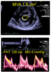 Summary : This figure presents two echocardiographic images assessing mitral valve stenosis, including mitral valve area (MVA), pressure half-time (PHT), and mean gradient (MG).
photo:
# Top Panel :
• Echocardiographic image (likely parasternal short-axis view) of the mitral valve.
• The mitral valve orifice is outlined with yellow dots.
• On-image text: "MVA 1.6 cm²" indicating mitral valve area measurement.
• Additional ultrasound machine interface text and settings visible on the right.
# Bottom Panel :
• Doppler echocardiography tracing showing transmitral flow velocity over time.
• Yellow dots trace the E-wave deceleration slope.
• On-image text: "PHT 128 ms" (pressure half-time) and "MG 6 mmHg" (mean gradient).
• Additional ultrasound machine interface text and settings visible on the right.
# Technical Details :
• No scale bar or magnification specified.
• Modality: 2D echocardiography (top), pulsed-wave Doppler (bottom).
• Colour palette: grayscale for anatomical image, pink/red for Doppler tracing, yellow for annotation.
• On-image UI elements: measurement values, machine settings, patient data (partially visible).
# Spatial Relationships :
• Top panel focuses on the mitral valve orifice in cross-section.
• Bottom panel displays time-velocity Doppler tracing, with measurements annotated.
# Analysis :
• The mitral valve area (MVA) is reduced (1.6 cm²), consistent with mitral stenosis.
• Pressure half-time (PHT) is 128 ms and mean gradient (MG) is 6 mmHg, supporting the diagnosis and quantification of mitral stenosis severity.
• The figure visually demonstrates both anatomical narrowing and haemodynamic consequences.