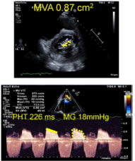 Summary : This figure presents two echocardiographic images assessing mitral valve stenosis, including planimetry and Doppler measurements, with key values for mitral valve area (MVA), pressure half-time (PHT), and mean gradient (MG) annotated.
photo:
# Top Panel : Mitral Valve Planimetry
• Black-and-white echocardiographic image showing a cross-sectional view of the mitral valve.
• Yellow annotation: "MVA 0.87 cm²" indicating the mitral valve area measured by planimetry.
• The mitral valve orifice is outlined with yellow dashed lines.
• Standard ultrasound interface elements (depth scale, probe orientation, grayscale bar) visible.
• Green ECG trace at the bottom of the image.
# Bottom Panel : Doppler Assessment
• Spectral Doppler tracing of mitral inflow velocities.
• Yellow annotations: "PHT 226 ms" (pressure half-time) and "MG 18mmHg" (mean gradient).
• Doppler envelope outlined with yellow dashed lines and arrows.
• Standard ultrasound interface elements (velocity scale, colour bar, measurement table) visible.
• Multiple cardiac cycles shown, with velocity peaks and troughs.
# Technical Details :
• Adult echocardiography modality.
• Measurements: MVA (cm²), PHT (ms), MG (mmHg).
• Image orientation and probe position indicated by icons.
• No scale bar, but standard echocardiographic depth and velocity scales present.
# Analysis :
• The mitral valve area (0.87 cm²) is below the normal threshold, indicating significant mitral stenosis.
• Pressure half-time (226 ms) and mean gradient (18 mmHg) are elevated, supporting the diagnosis of hemodynamically significant mitral stenosis.
• Both planimetry and Doppler methods are used to quantify severity, with consistent findings across modalities.