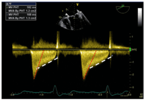 Summary : This image shows a Doppler echocardiography spectral tracing of mitral inflow, used to assess mitral valve area (MVA) by pressure half-time (PHT) method, with on-image measurements and calculations.
